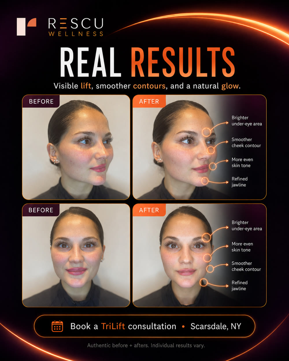 TriLift case study detail — brighter under-eye area and smoother cheek contour on the same client
