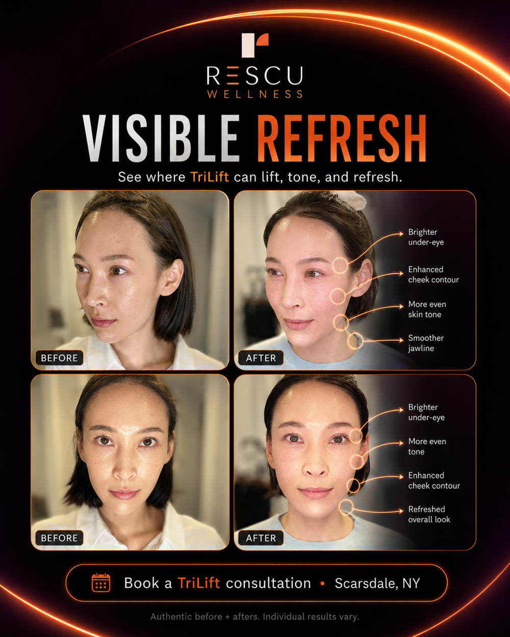 TriLift case study detail — more even skin tone and a refined jawline on the same client