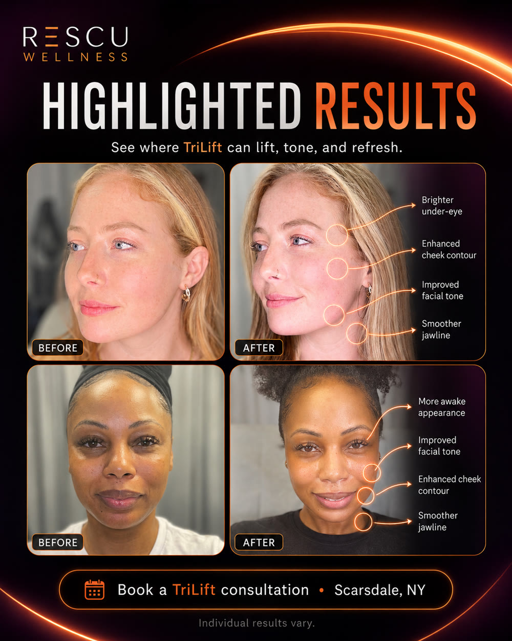 TriLift before and after — real Rescu clients across skin tones showing improved facial tone, enhanced cheek contour, and smoother jawline