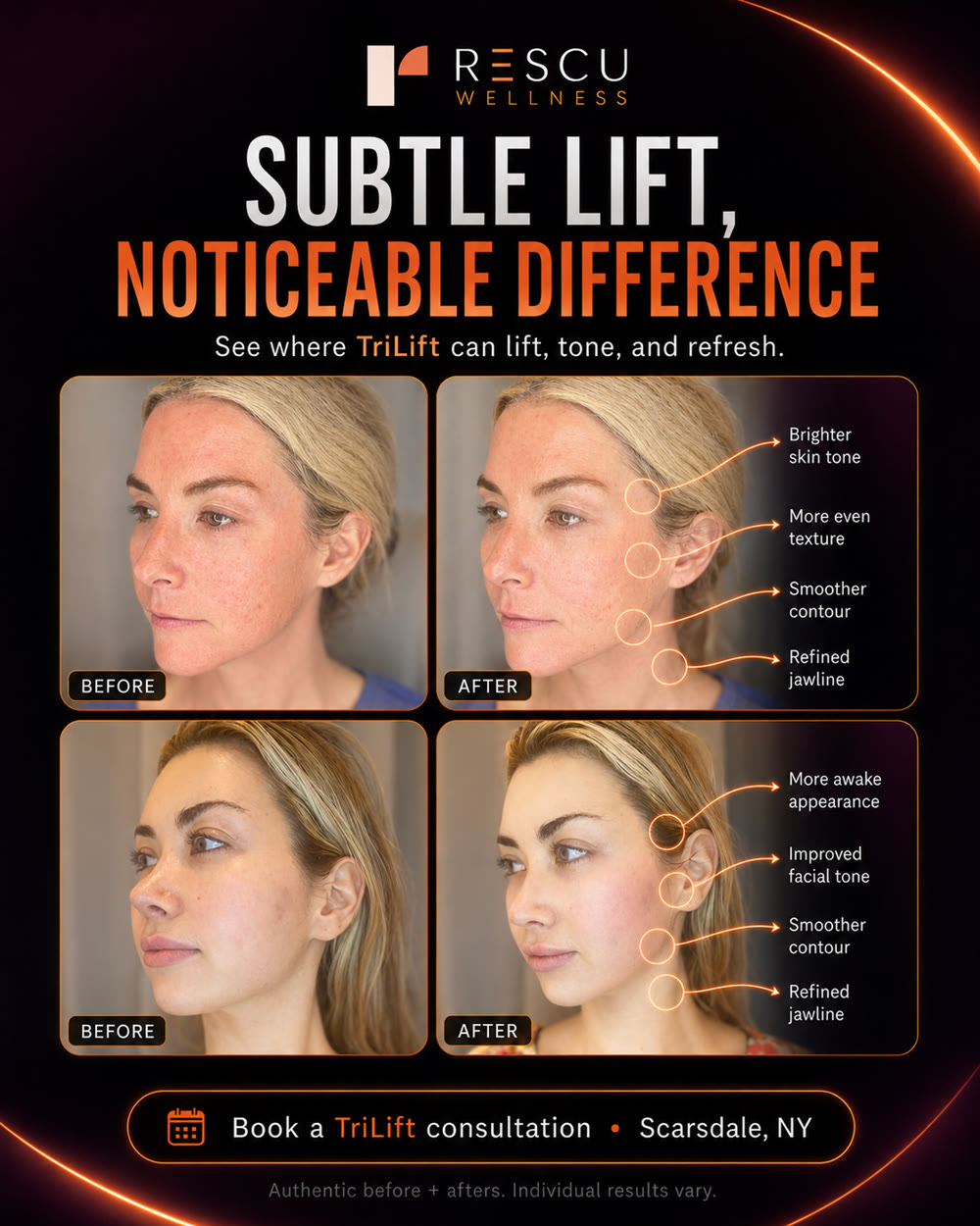 TriLift before and after — real Rescu client showing brighter skin tone, smoother contour, and refined jawline