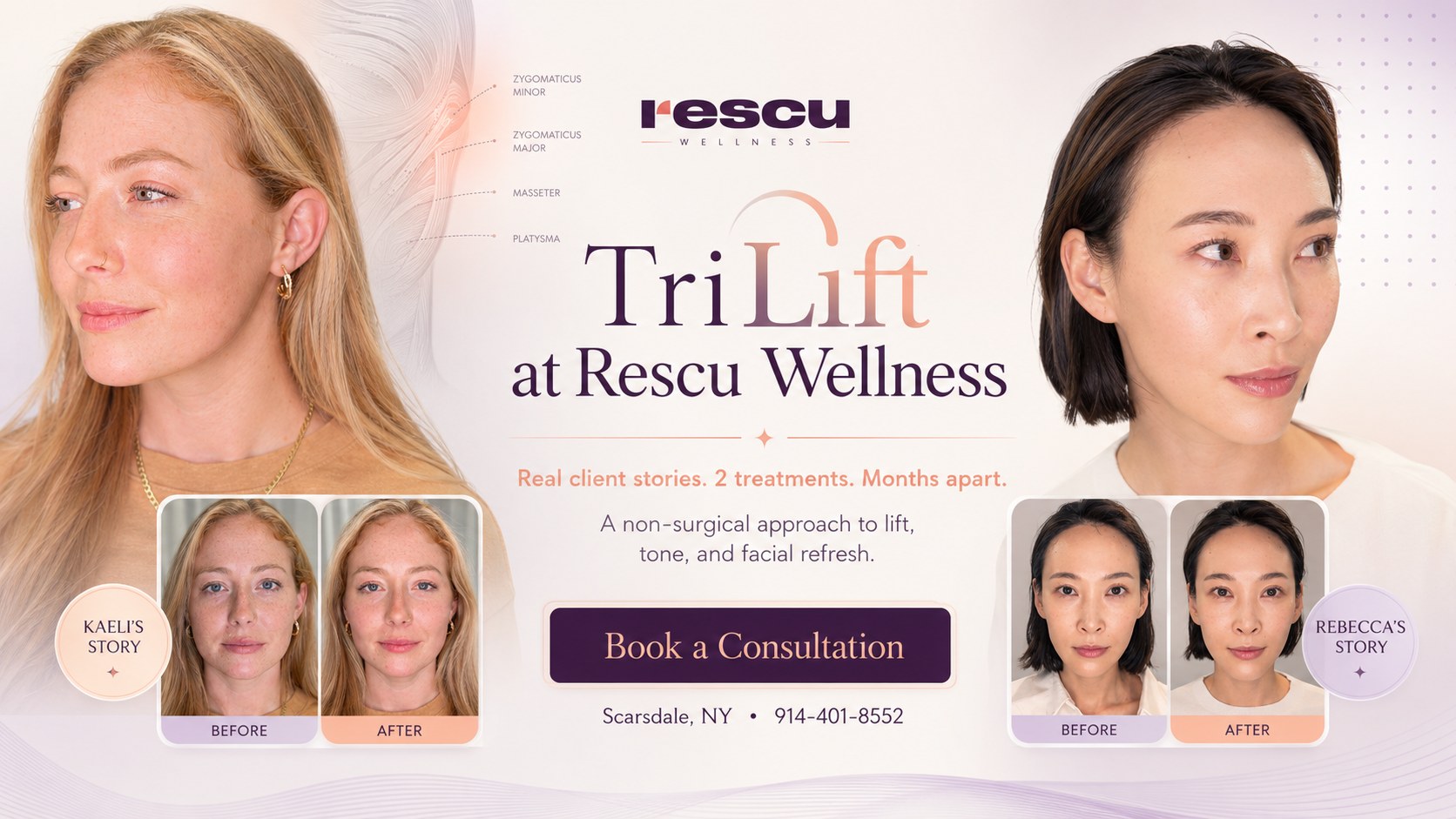 TriLift at Rescu Wellness — physician-performed facial sculpting, no needles, no downtime