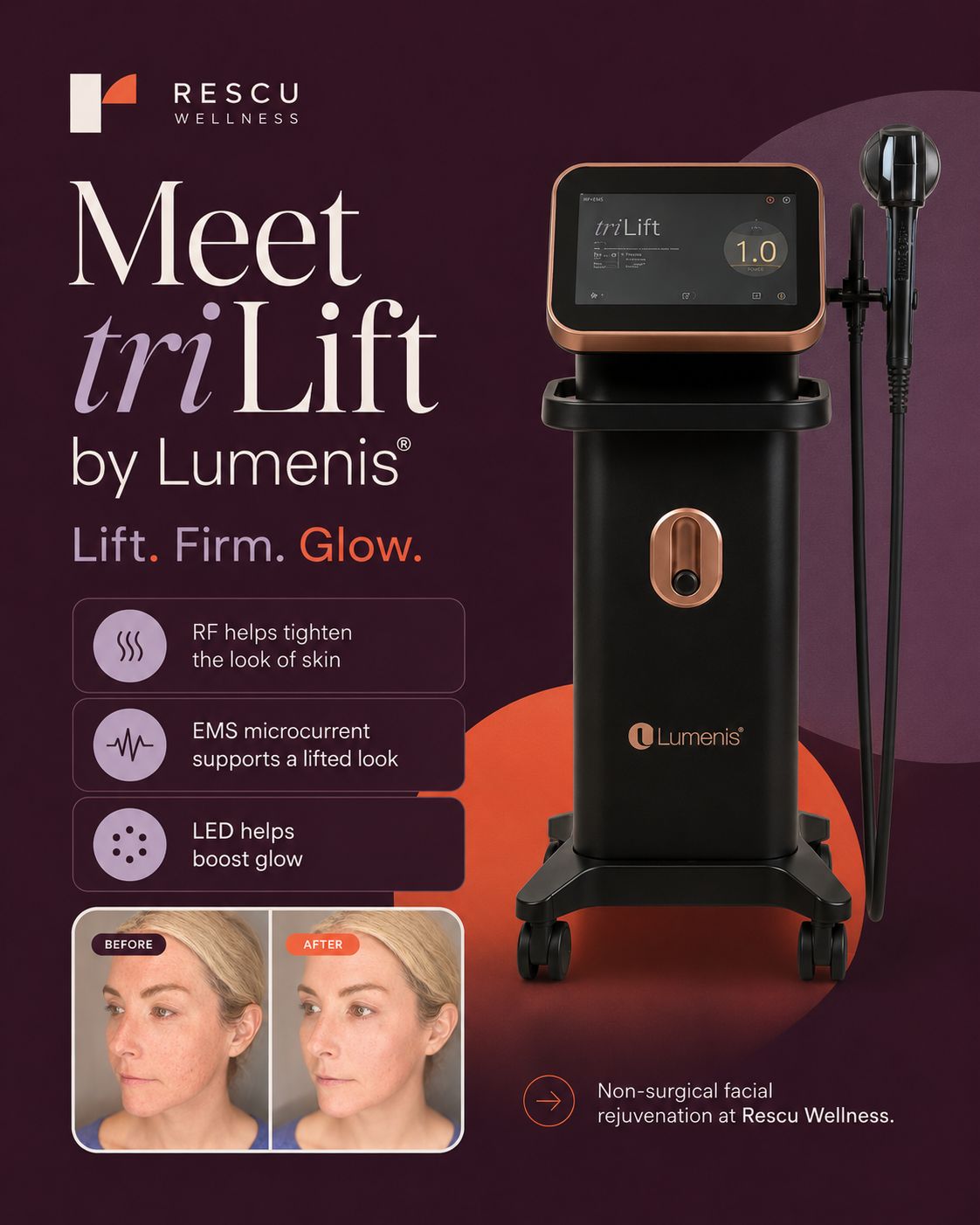 The TriLift device — dynamic muscle stimulation plus radiofrequency